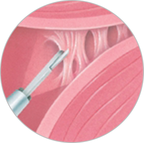 Adezioliza (operatia prin care se sectioneaza aderentele)