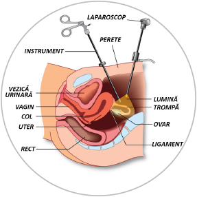 Procedura laparoscopica