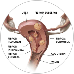 Diferite tipuri si localizari ale fibroamelor