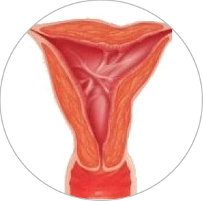 Aderente intrauterine (sinechii uterine)