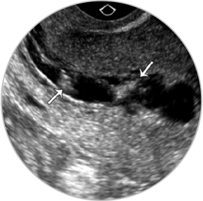 Sinechii uterine vizibile ecografic